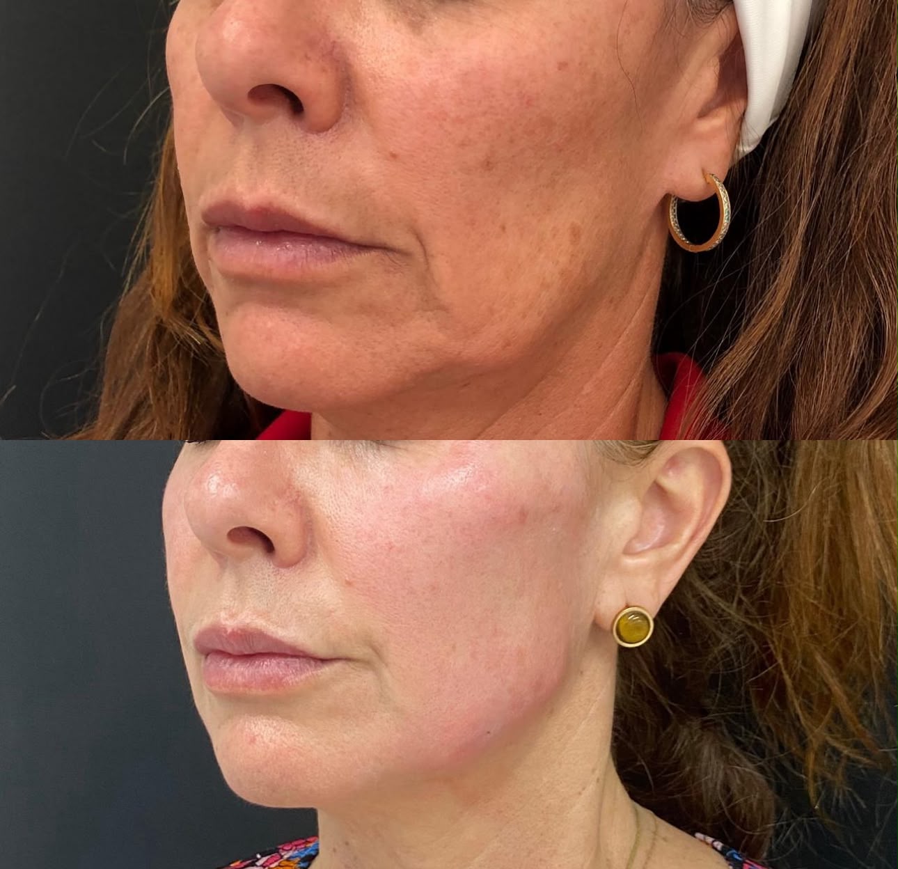 Antes e depois: Bioestimuladores de Colágeno