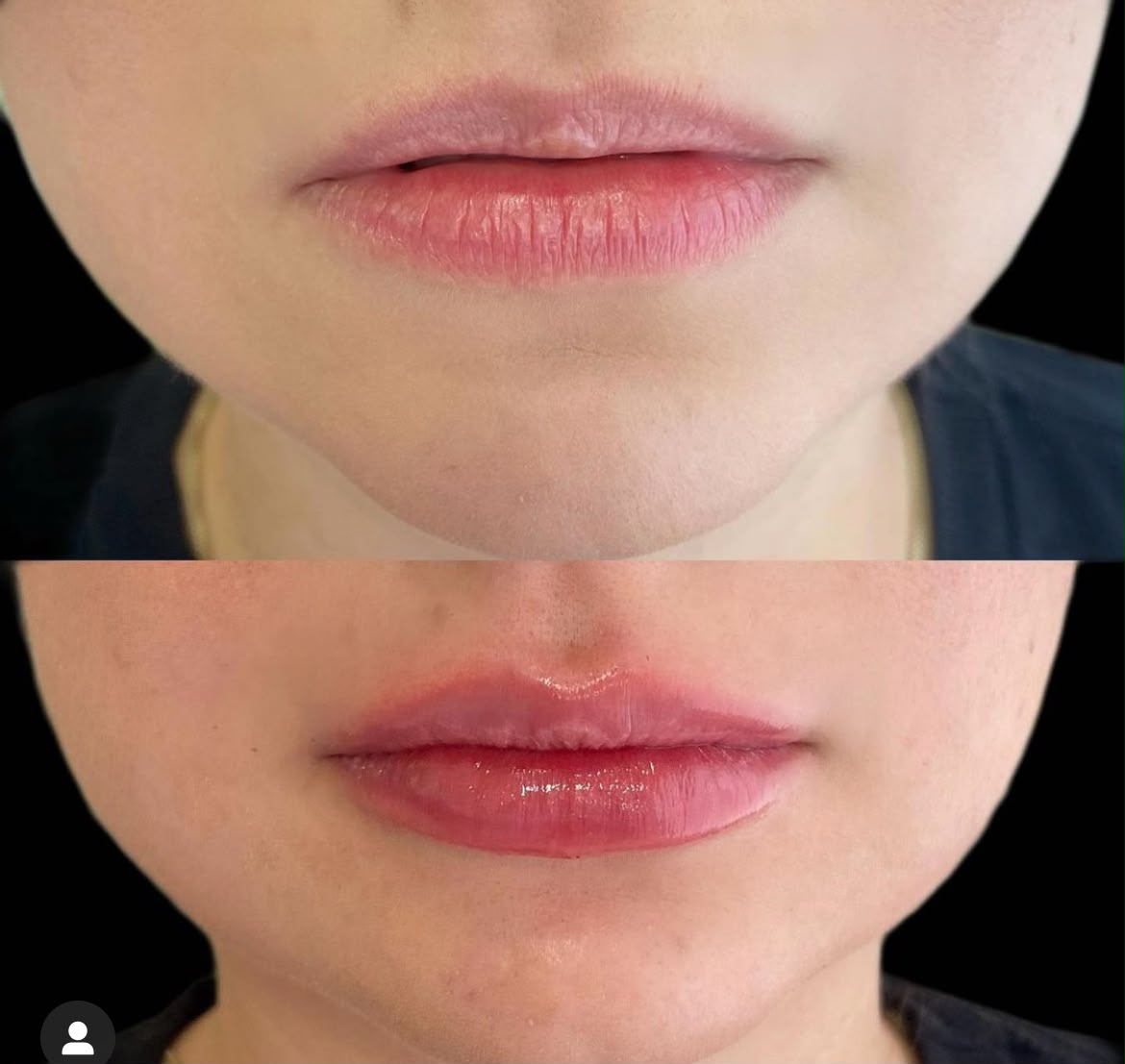 Antes e depois: Harmonização Labial