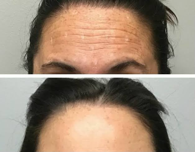 Antes e depois: Botox