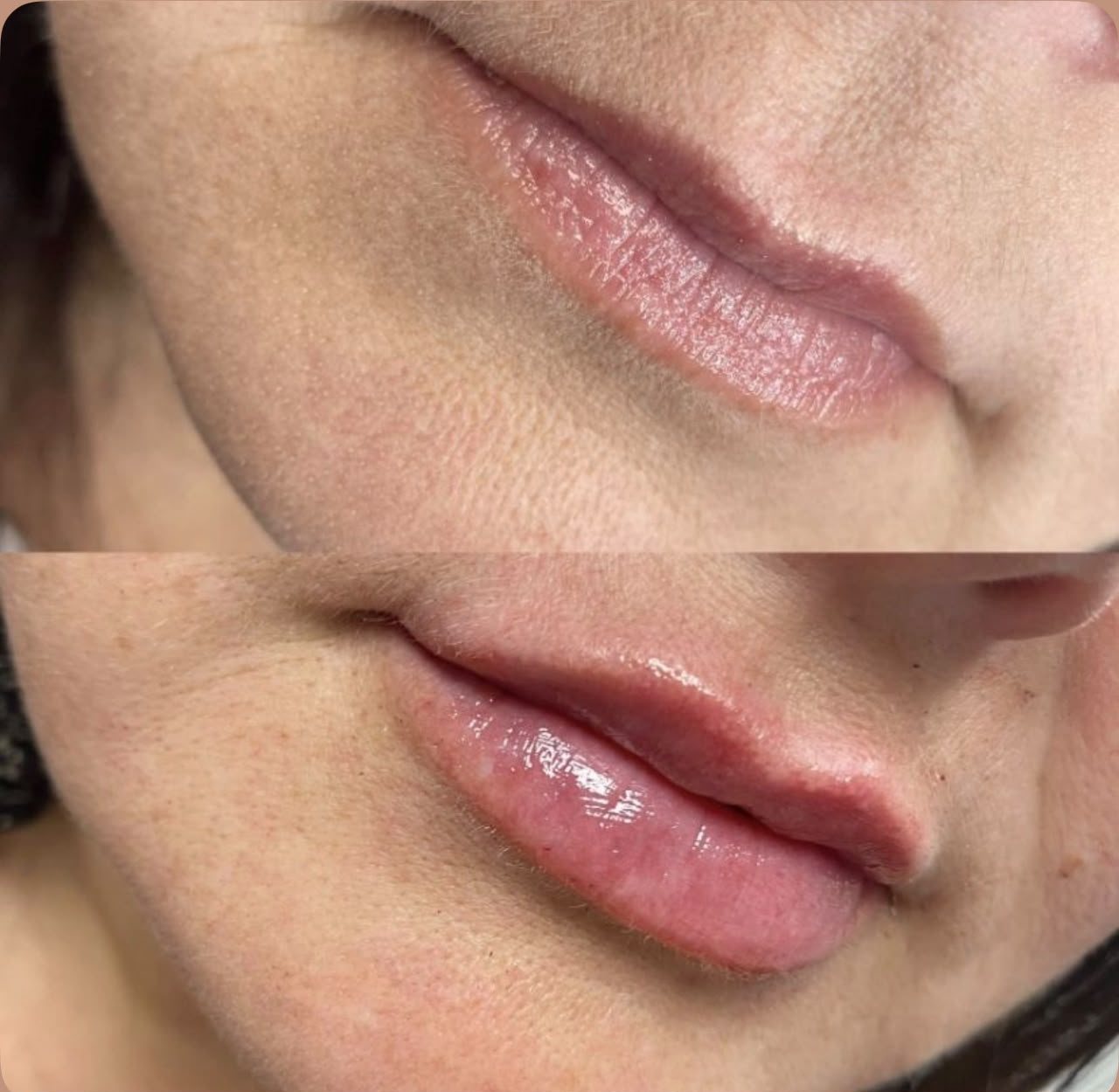 Antes e depois: Harmonização Labial