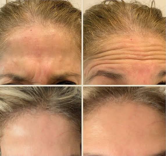 Antes e depois: Botox